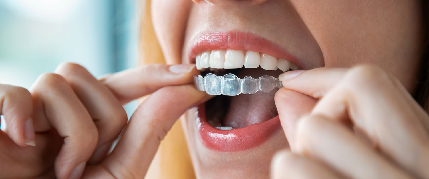 Close-up of a person‚Äôs mouth as they use their fingers to insert a clear orthodontic aligner over their upper teeth.